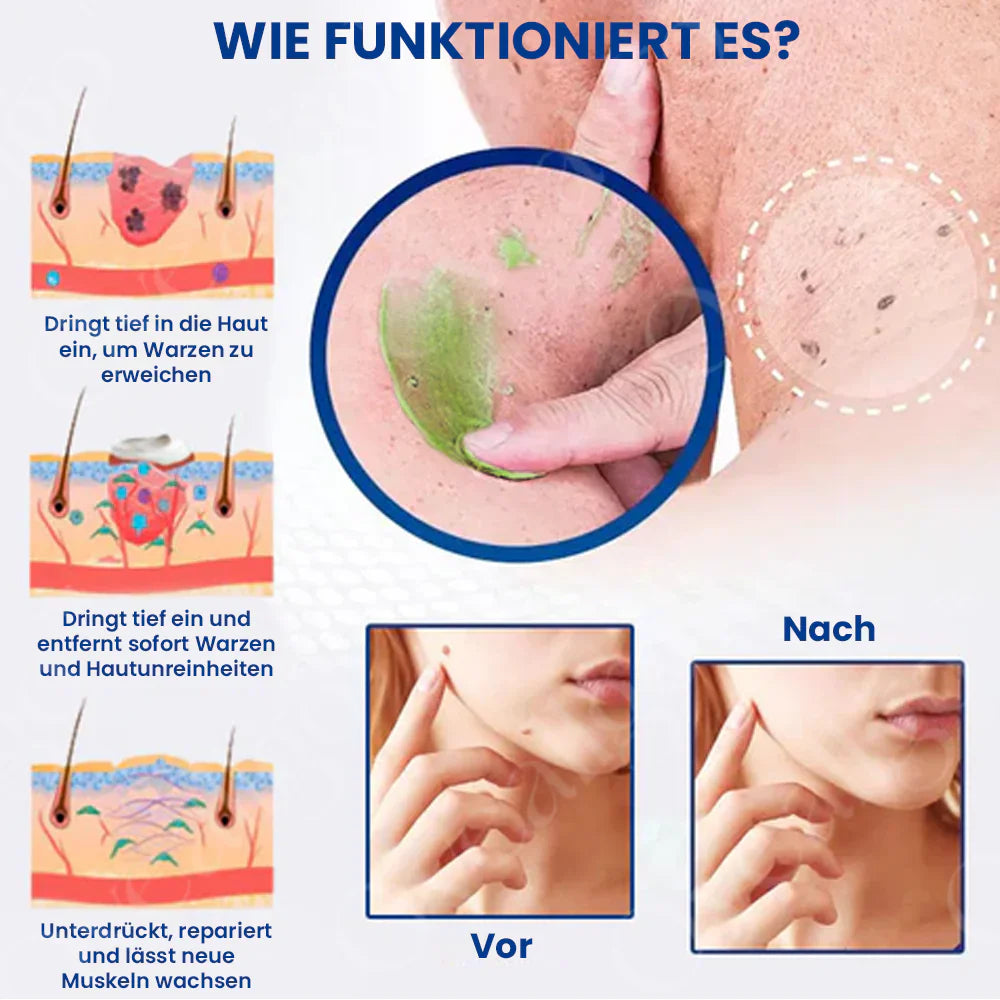 ✅ Offizieller Laden: Oveallgo® NatureErase ULTRA Sofortige Maulwurf- und Fleckencreme