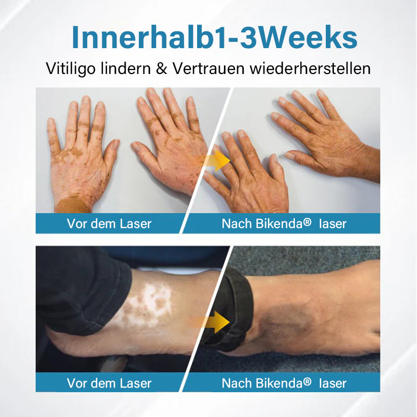 Bikenda® EVENA Profi Vitiligo Lichttherapie Gerät
