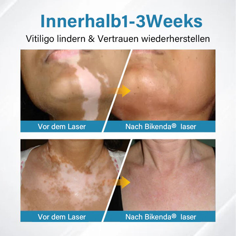Bikenda® EVENA Profi Vitiligo Lichttherapie Gerät