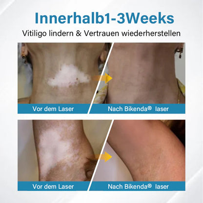 Bikenda® EVENA Profi Vitiligo Lichttherapie Gerät