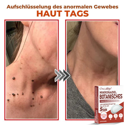 Oveallgo® PROFI MikroNadel Botanisches Tag-Clear-Pflaster 🇩🇪 Hergestellt in der Germany