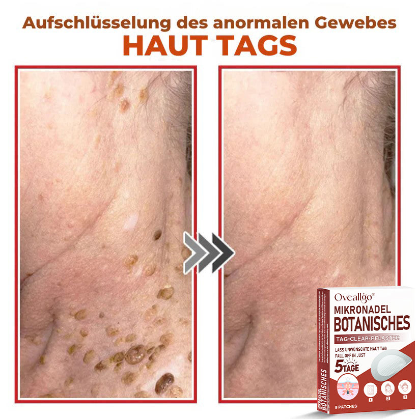 Oveallgo® PROFI MikroNadel Botanisches Tag-Clear-Pflaster 🇩🇪 Hergestellt in der Germany