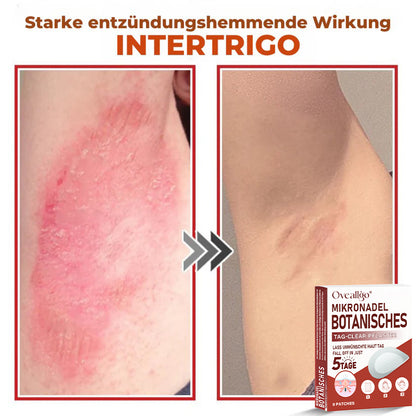 Oveallgo® PROFI MikroNadel Botanisches Tag-Clear-Pflaster 🇩🇪 Hergestellt in der Germany