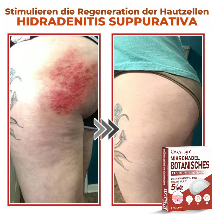 Oveallgo® PROFI MikroNadel Botanisches Tag-Clear-Pflaster 🇩🇪 Hergestellt in der Germany