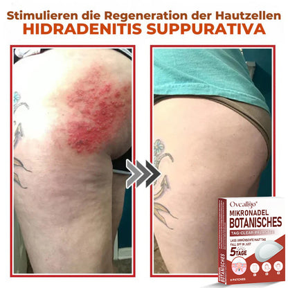 Oveallgo® PROFI MikroNadel Botanisches Tag-Clear-Pflaster 🇩🇪 Hergestellt in der Germany