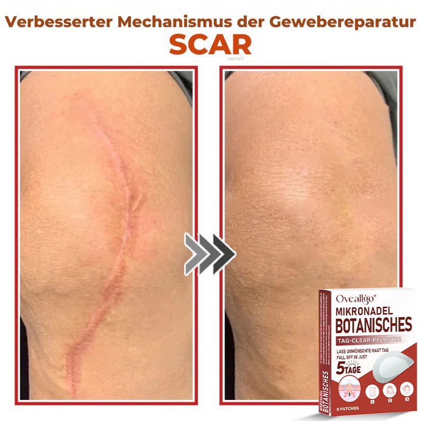 Oveallgo® PROFI MikroNadel Botanisches Tag-Clear-Pflaster 🇩🇪 Hergestellt in der Germany