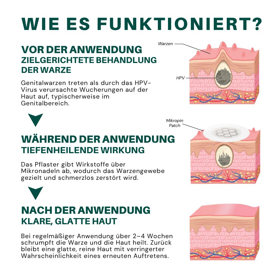 Fivfivgo® Magnesium ULTRA Mikropin HPV Genitalien Warzen Entfernung Patch
