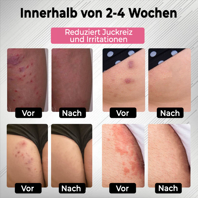 Fivfivgo® HPV-Genitalwarzen-Pflege-Spray für Frauen