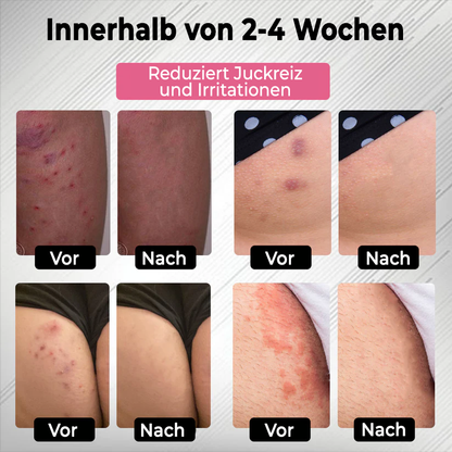 Fivfivgo® HPV-Genitalwarzen-Pflege-Spray für Frauen