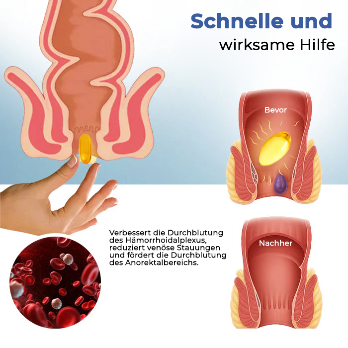 Oveallgo® Profi Natürliche Hämorrhoiden-Kapseln