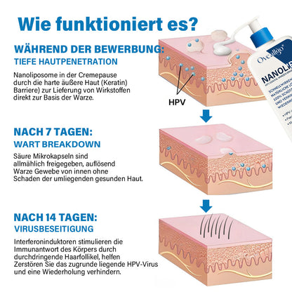 Oveallgo® ULTRA NanoLipo HPV Genital warzen-Eraser creme
