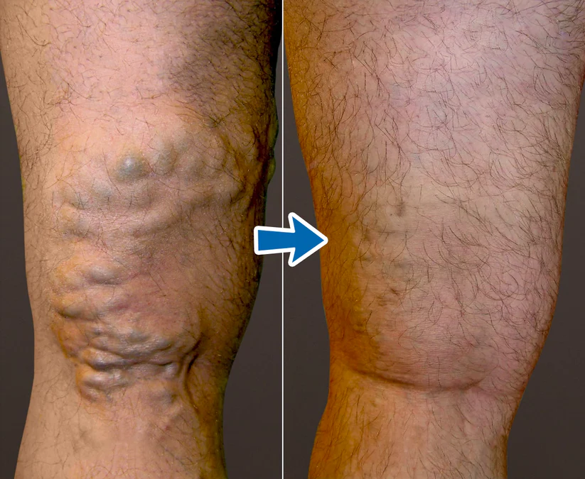 Cvreoz® VenoAid Profi Varizen-Lösungsspray