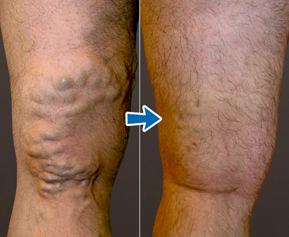 Cvreoz® VenoAid Profi Varizen-Lösungsspray