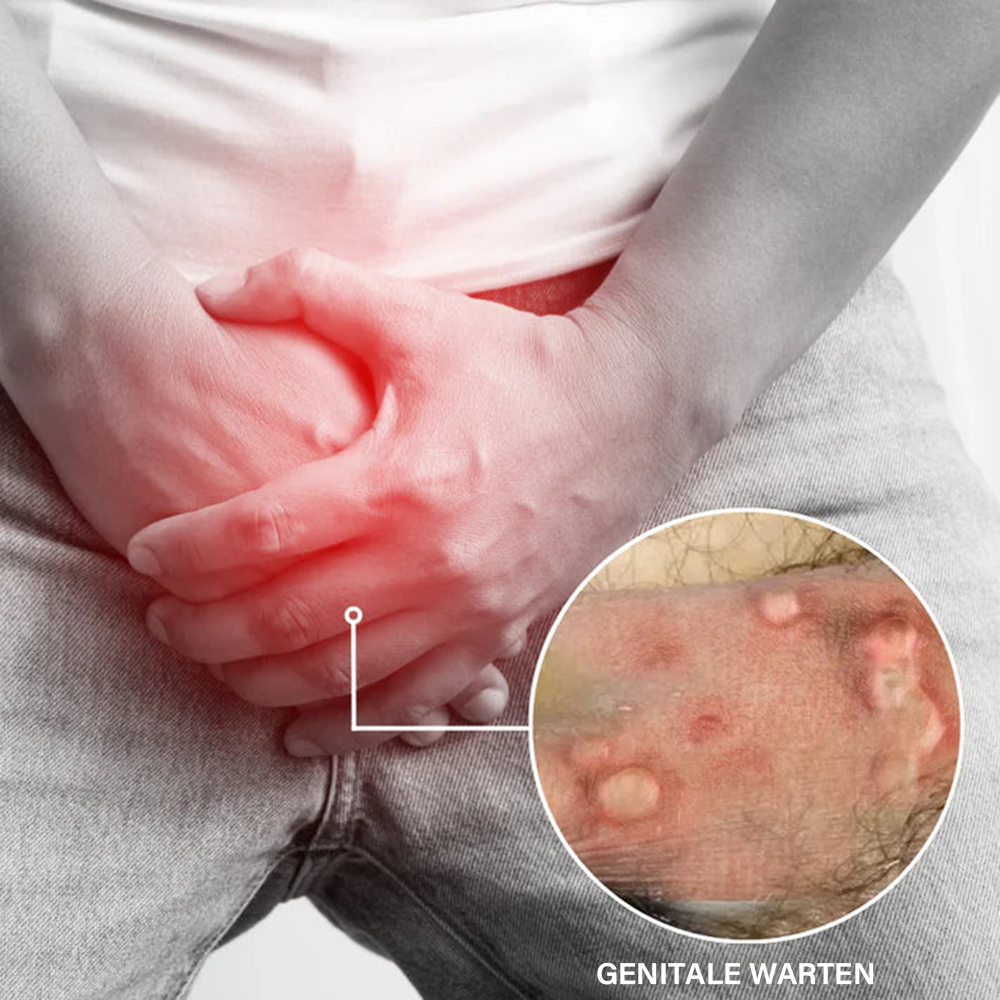 Oveallgo® AHCC Fungal HPV Genital Warts Removal Cream image Oveallgo® AHCC Fungal HPV Genital Warts Removal Cream