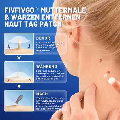 Fivfivgo® Muttermale & Warzen entfernen Haut Tag Patch