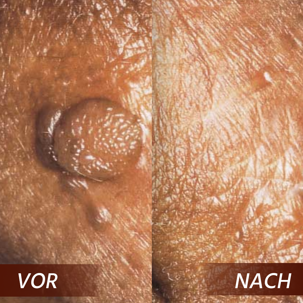 Oveallgo® AHCC Fungal HPV Genital Warts Removal Cream image Oveallgo® AHCC Fungal HPV Genital Warts Removal Cream