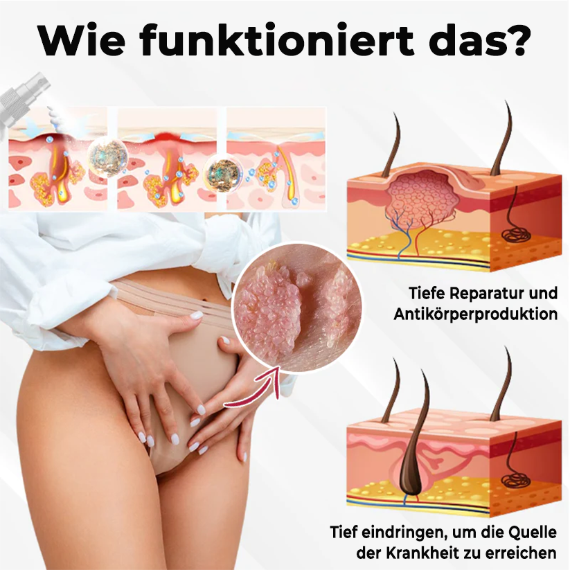 Fivfivgo® HPV-Genitalwarzen-Pflege-Spray für Frauen