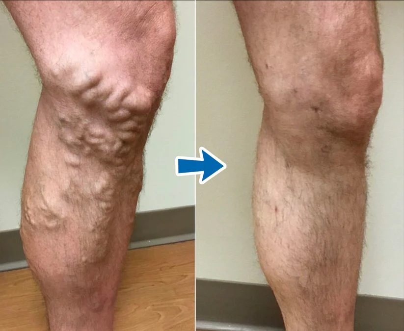 Cvreoz® VenoAid Profi Varizen-Lösungsspray