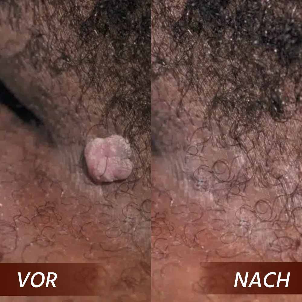 Oveallgo® AHCC Fungal HPV Genital Warts Removal Cream image Oveallgo® AHCC Fungal HPV Genital Warts Removal Cream