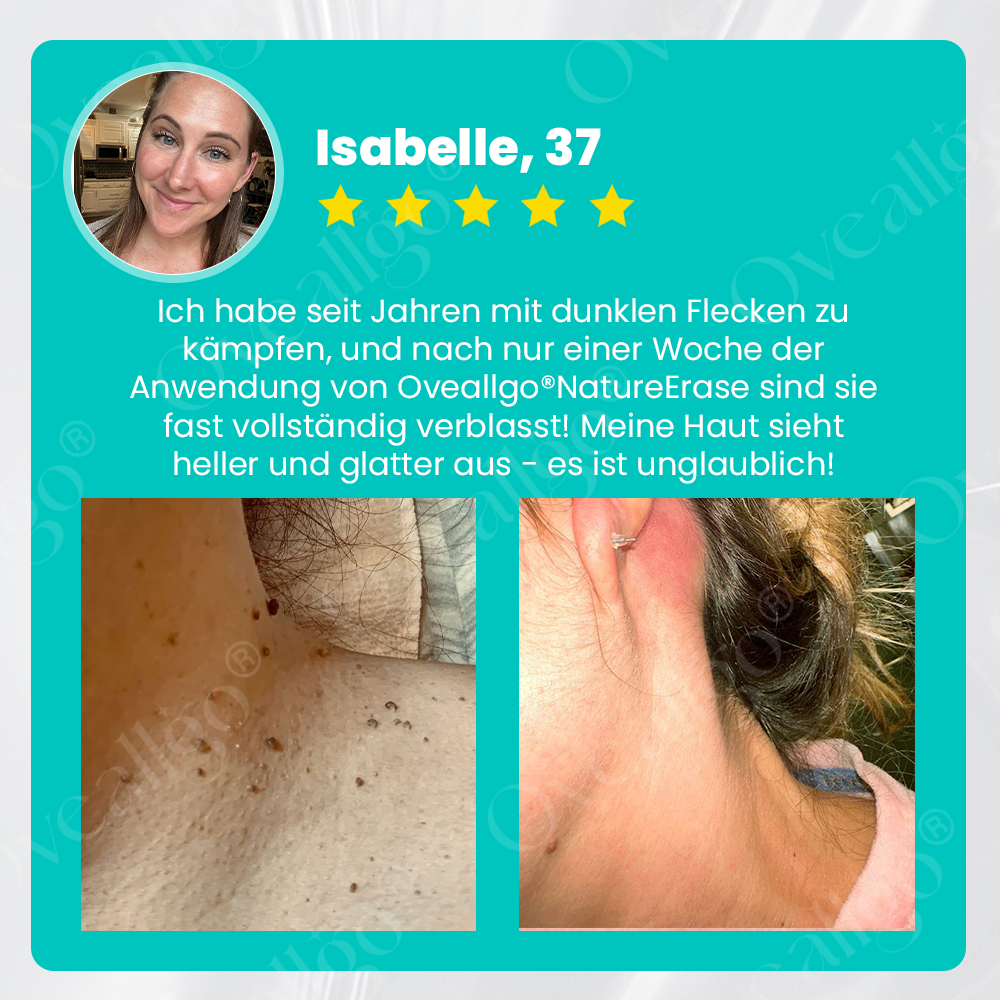 ✅ Offizieller Laden: Oveallgo® NatureErase Sofort Maulwurf & Flecken-Creme