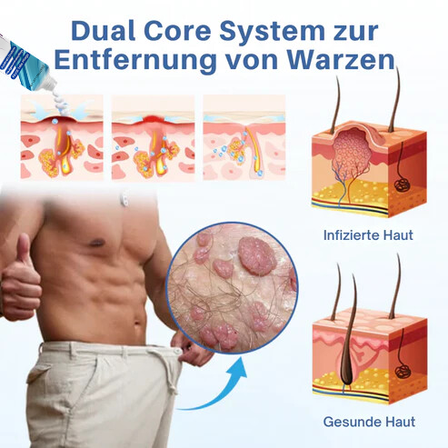 Oveallgo® Profi GentX Warzenentlastungs Creme