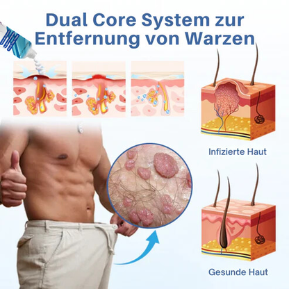 Oveallgo® Profi GentX Warzenentlastungs Creme