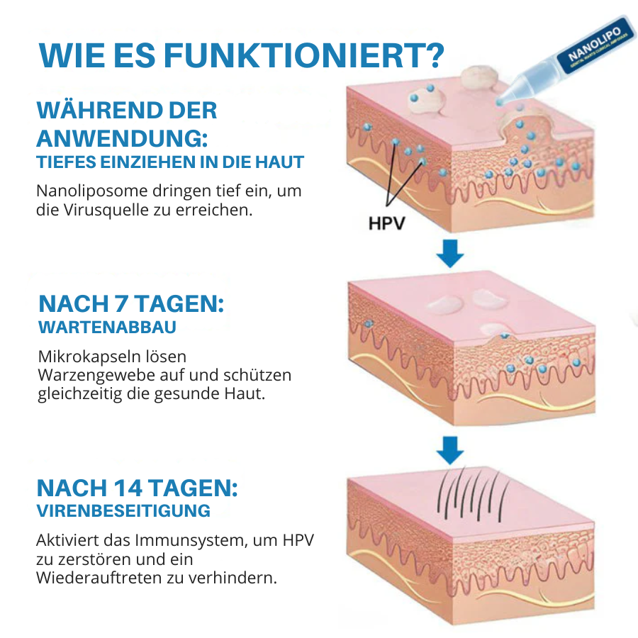 Oveallgo® Profi Nanolipo Genital Warzen Klinische Ampullen