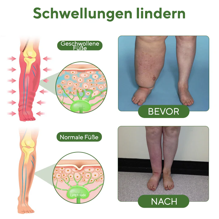 NovaRX® FluidEase PRO Beintherapie-Ödemcreme