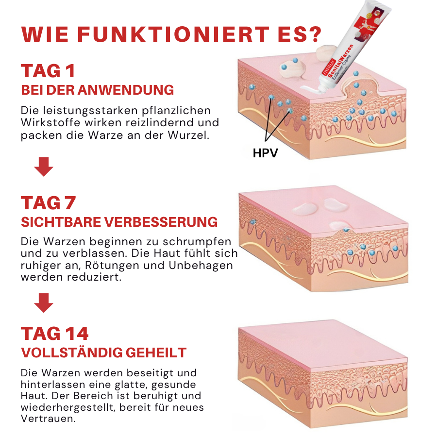 Fivfivgo® FloraGuard HPV Genitalwarzen-Entferner