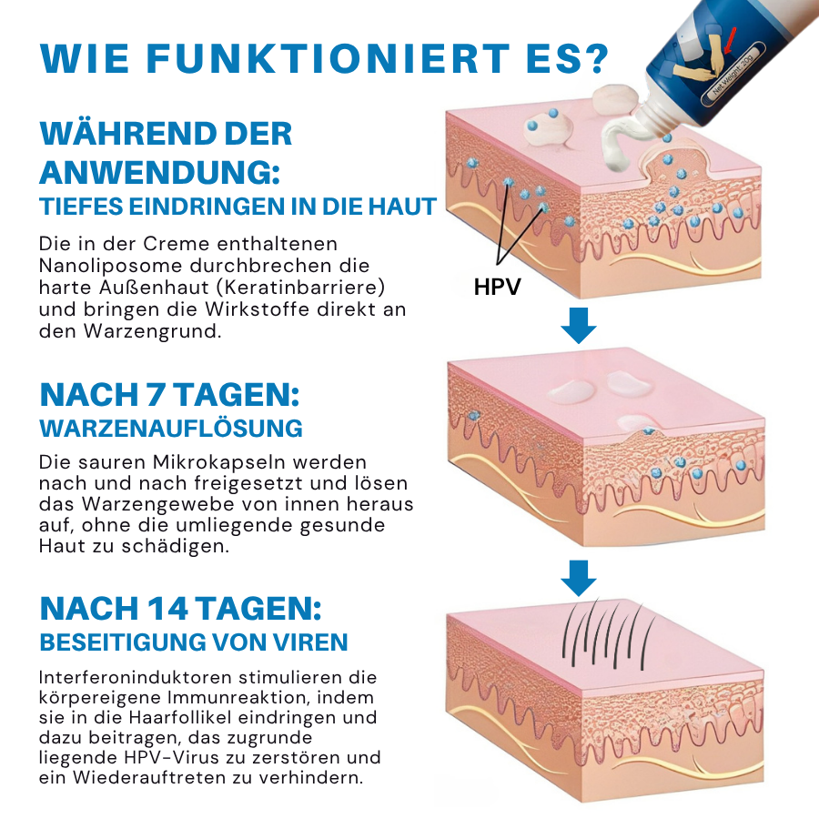 Fivfivgo® HPV-Creme ULTRA zur Linderung genitaler Warzen