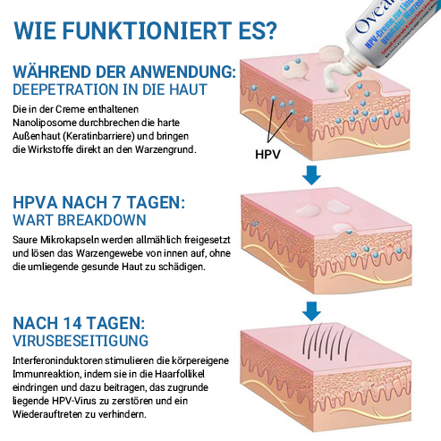 Oveallgo® ULTRA HPV-Creme zur Linderung genitaler Warzen