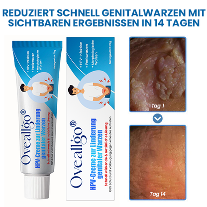 Oveallgo® ULTRA HPV-Creme zur Linderung genitaler Warzen