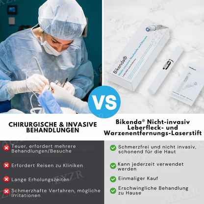 Bikenda® MAX Nicht-invasiv Leberfleck- und Warzenentfernungs-Laserstift
