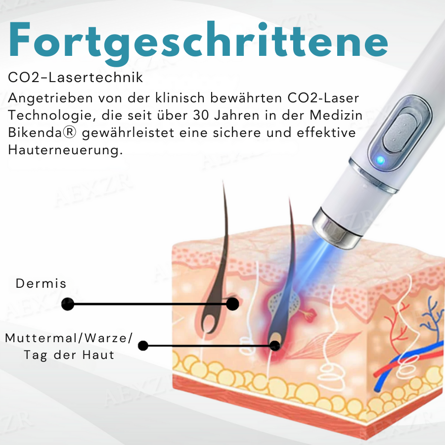 Bikenda® MAX Nicht-invasiv Leberfleck- und Warzenentfernungs-Laserstift